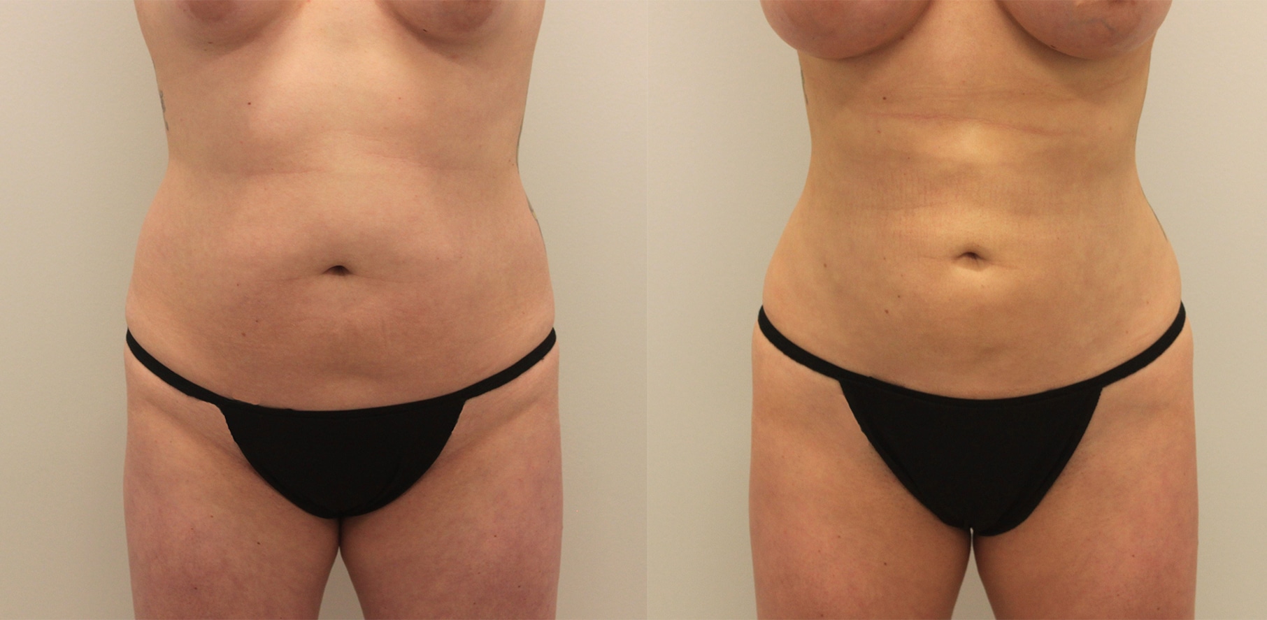 topless female patient before and after bodytite, stomach flatter after procedure