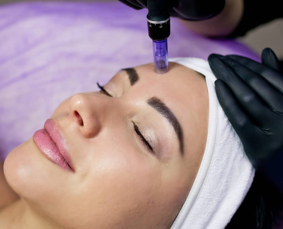 Three Reasons You Should Leave Microneedling to the Experts