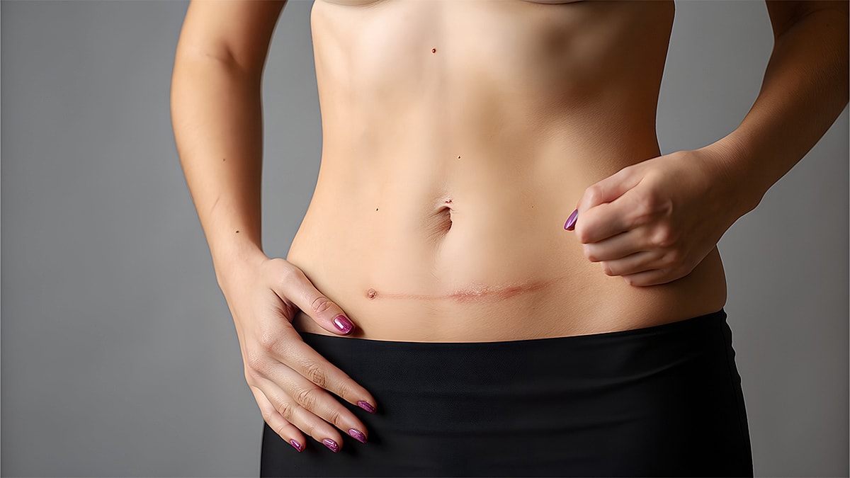 Bruising and Swelling After Tummy Tuck Surgery - Woman showing abdomen with visible scar.