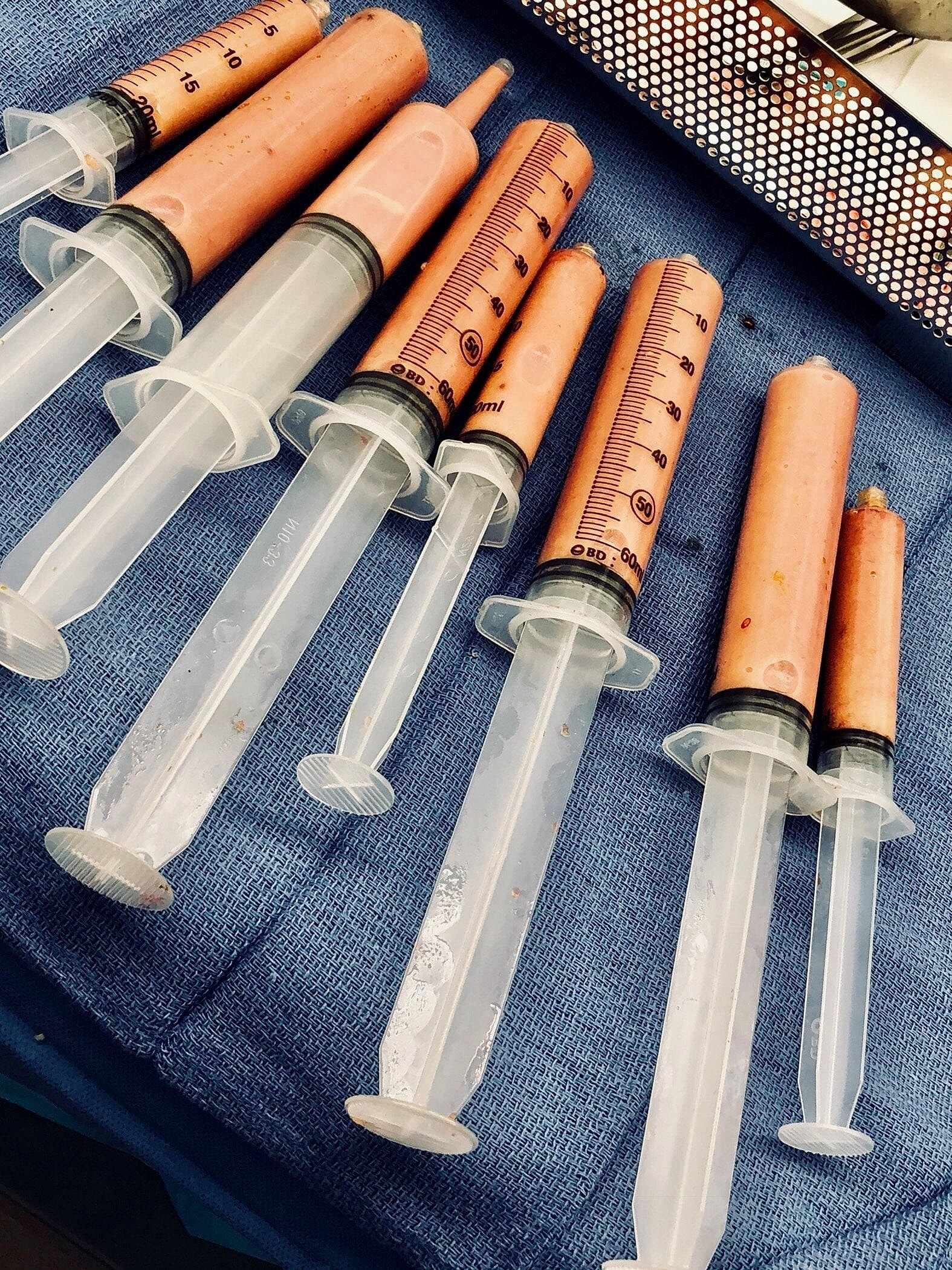 syringes filled with fat in preparation for a Fat Transfer