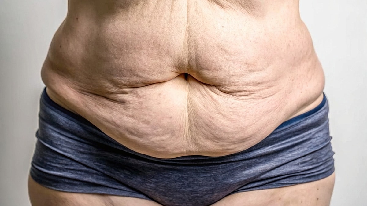 Dog Ears After Surgery- What Patients Should Know Feature Image - Close-up of a person's stomach and skin texture.