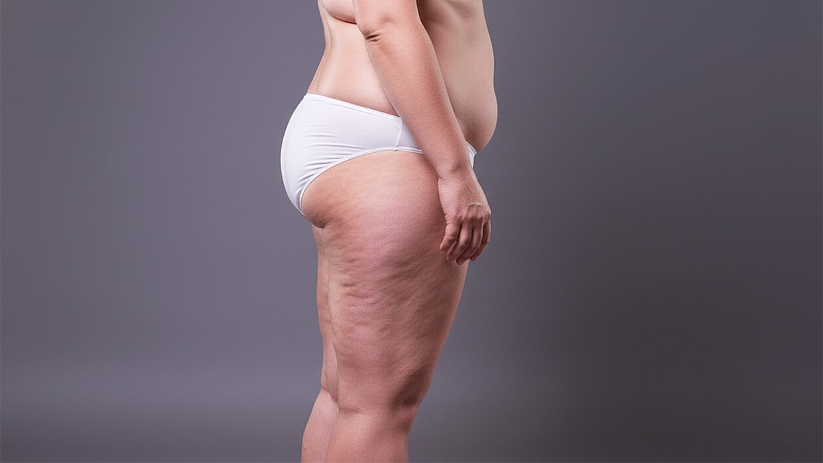 reating Thigh Cellulite and Buttock Cellulite: Why It Happens and How Aveli Can Help
