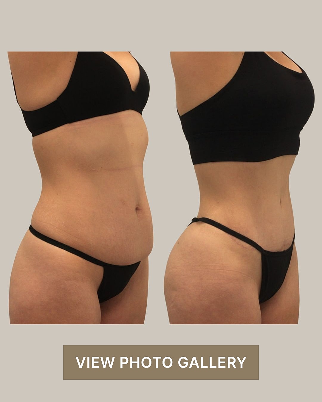 Houston tummy tuck before and after