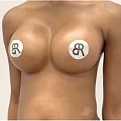 Houston breast augmentation patient after
