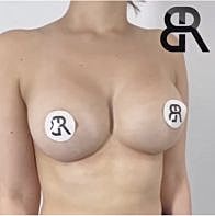 Houston breast augmentation patient after