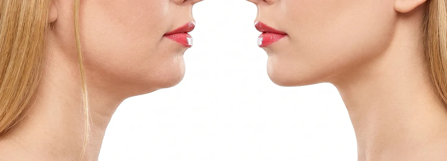 Neck Lift vs. Chin Liposuction