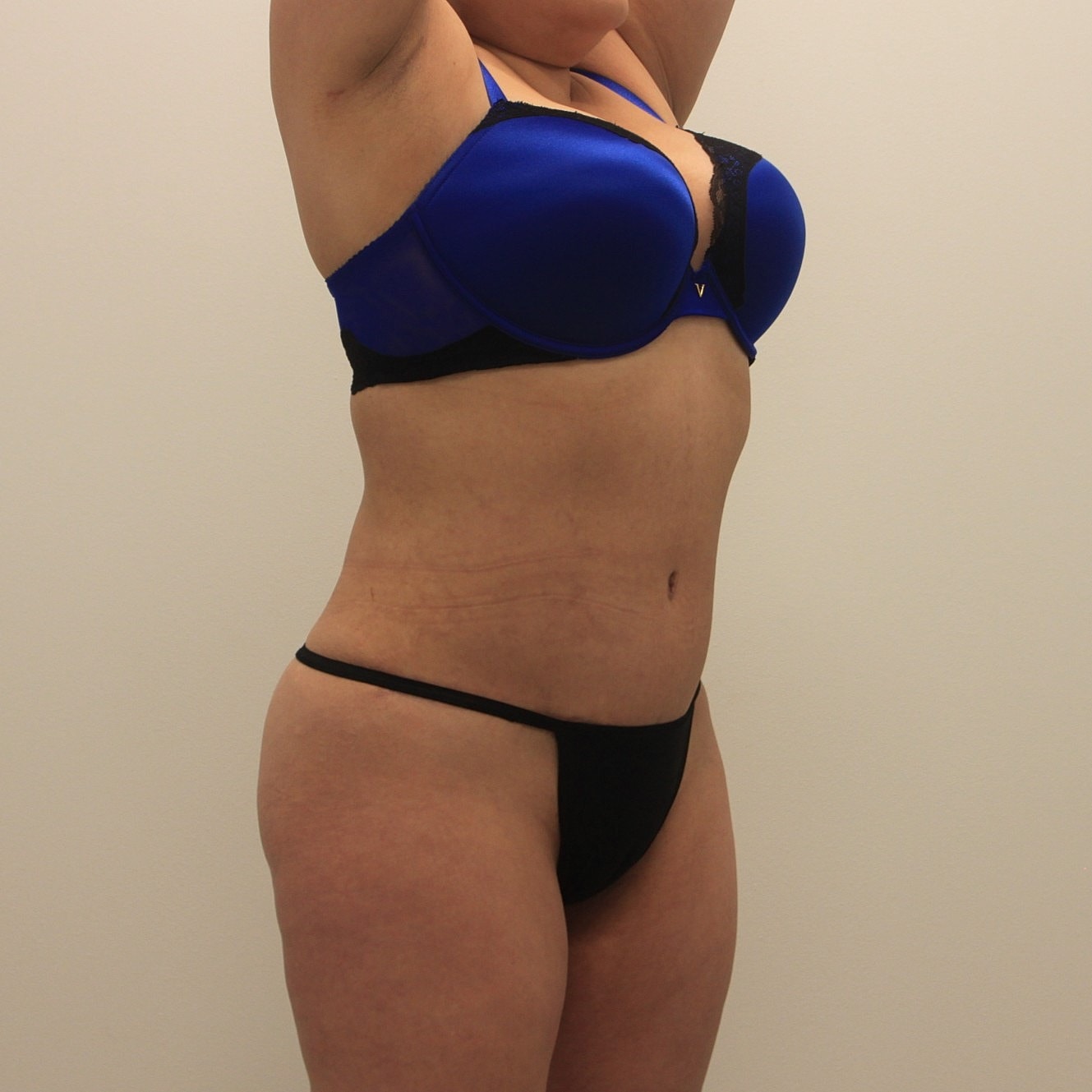 Tummy Tuck Before & After