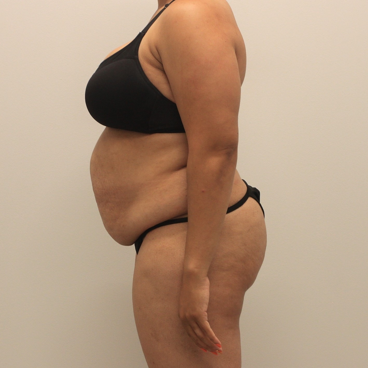 Tummy Tuck Before & After