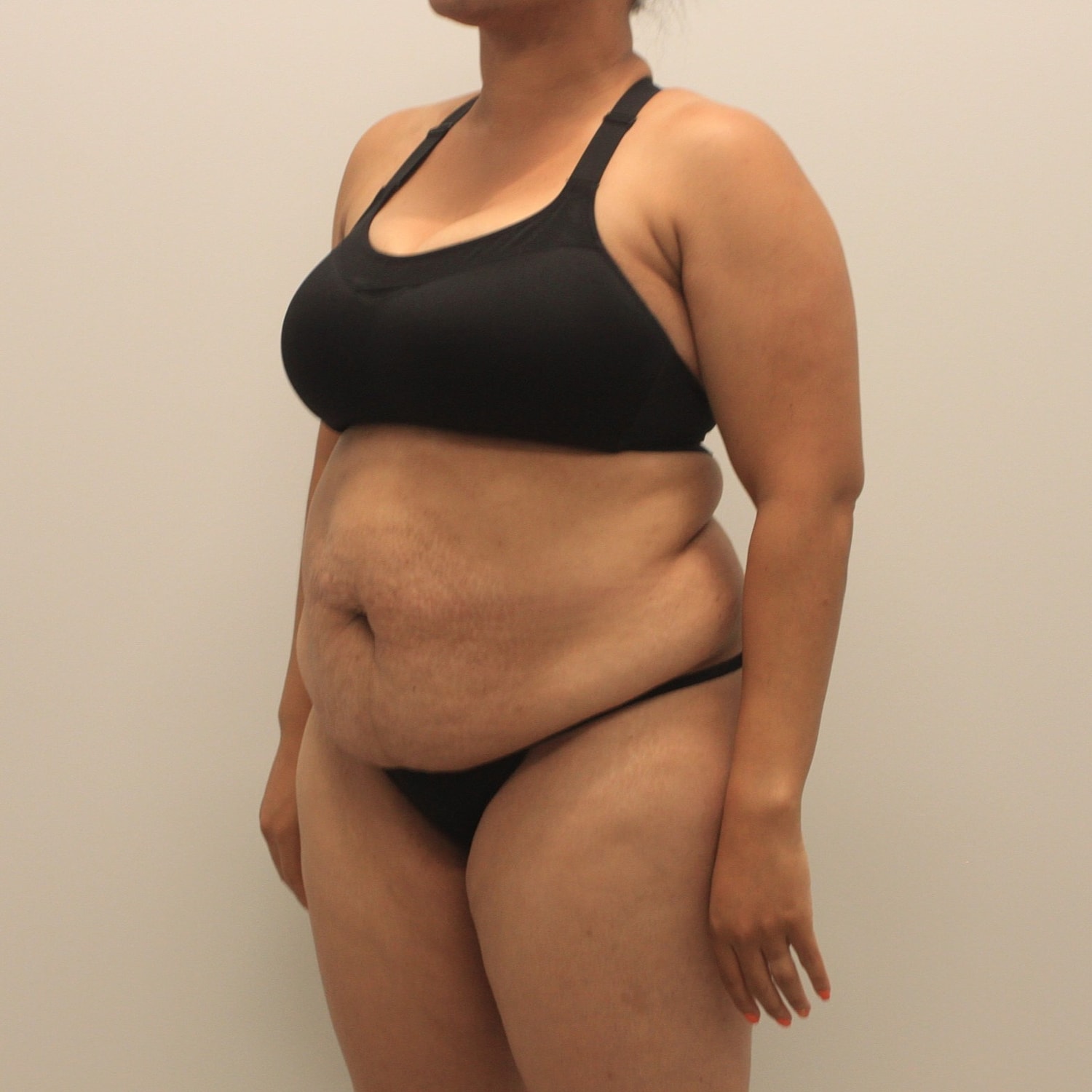 Tummy Tuck Before & After