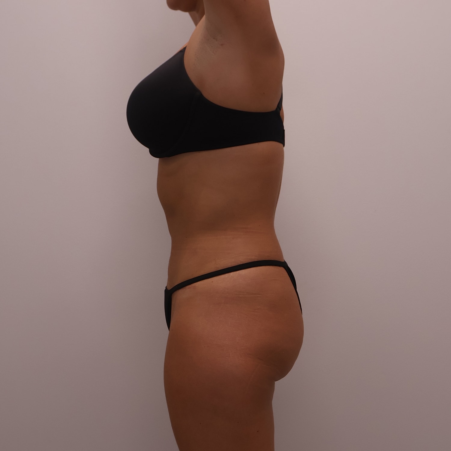 Tummy Tuck Before & After