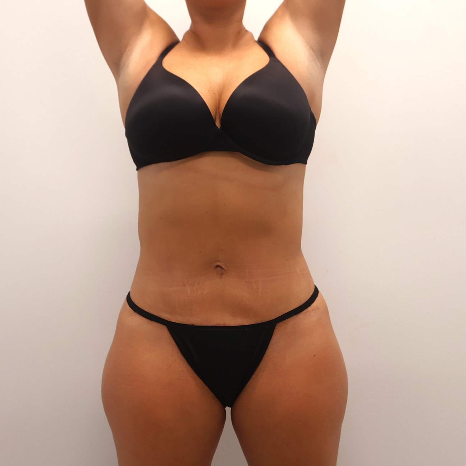 Tummy Tuck Before & After