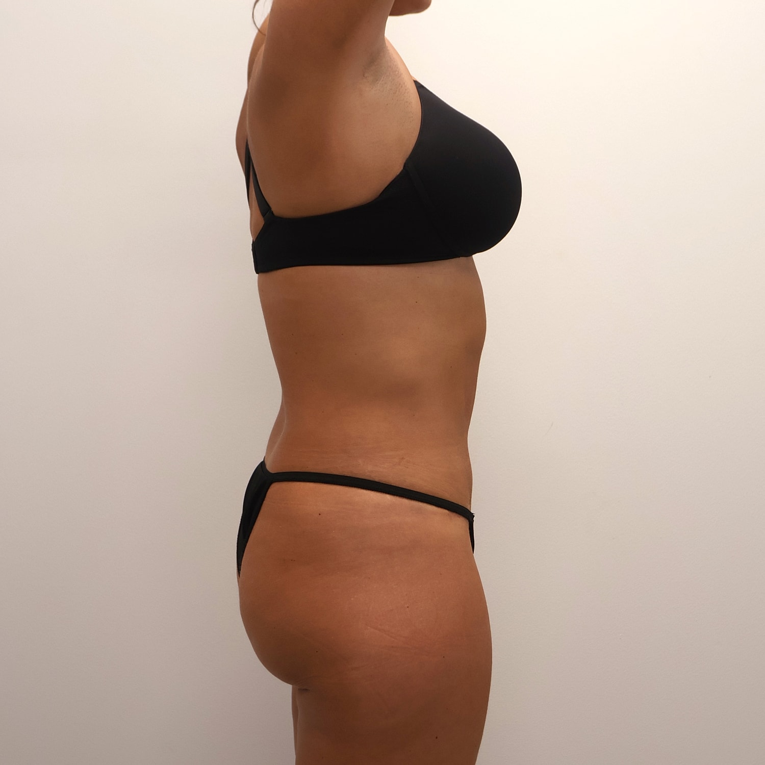 Tummy Tuck Before & After