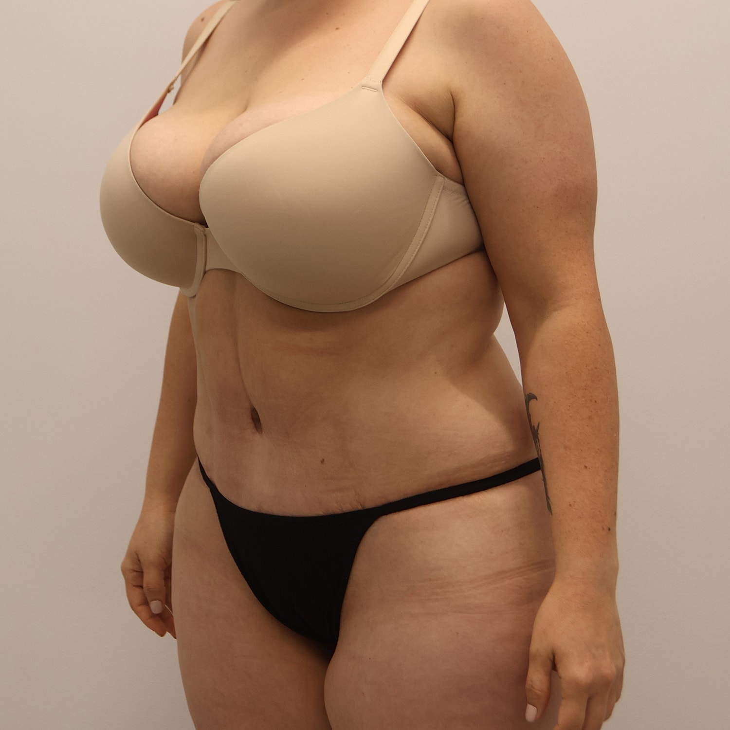 Tummy Tuck Before & After