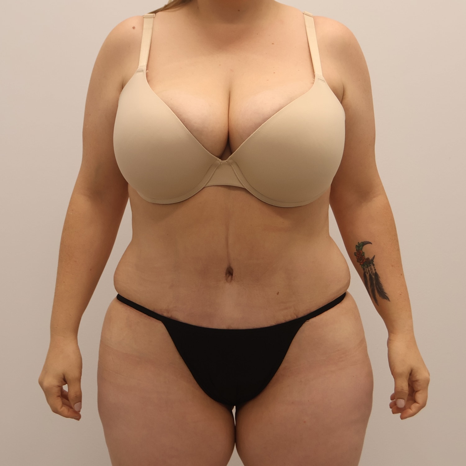 Tummy Tuck Before & After