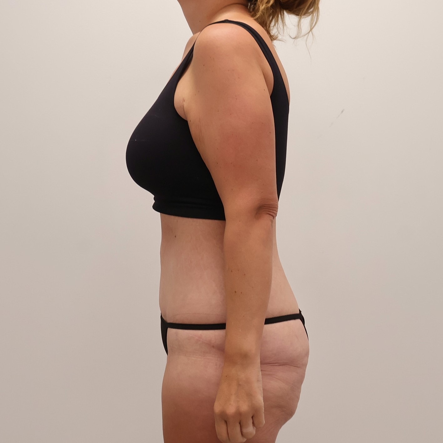 Tummy Tuck Before & After