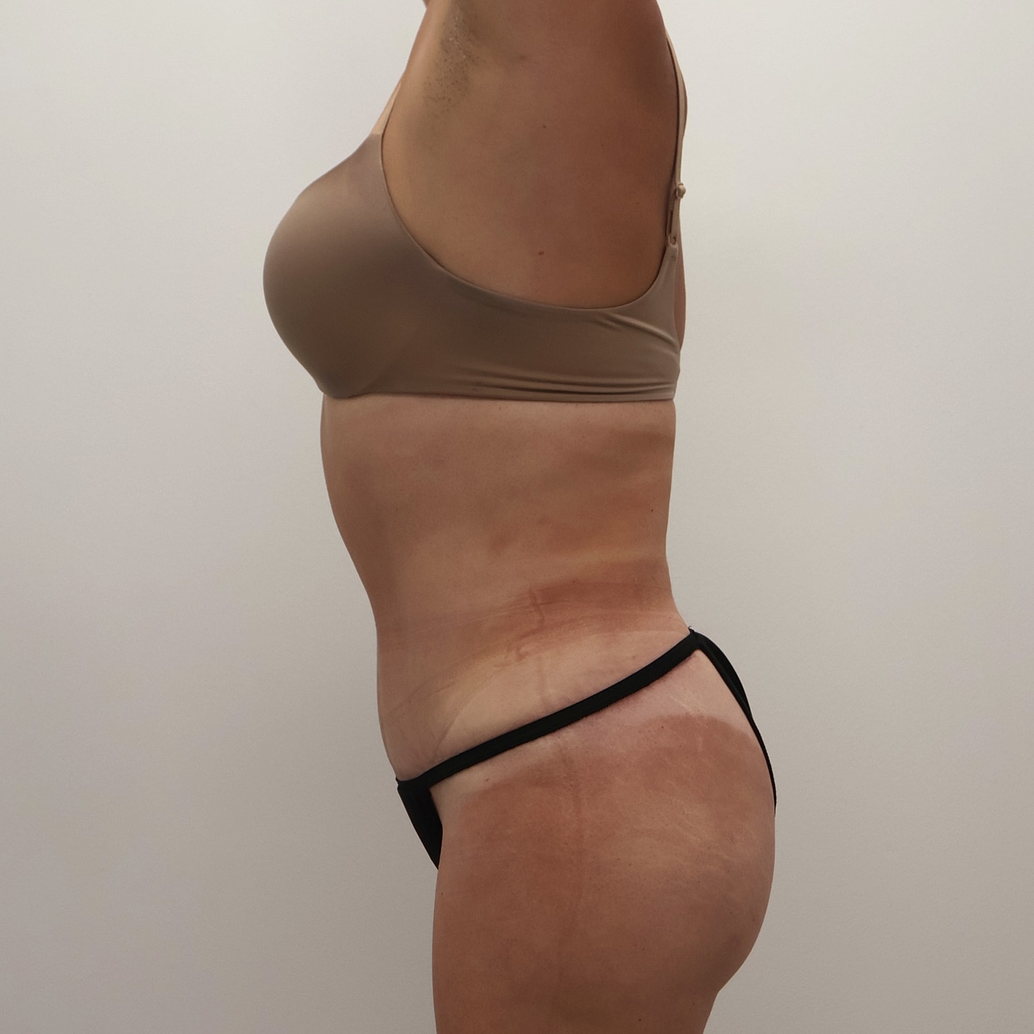 Tummy Tuck Before & After