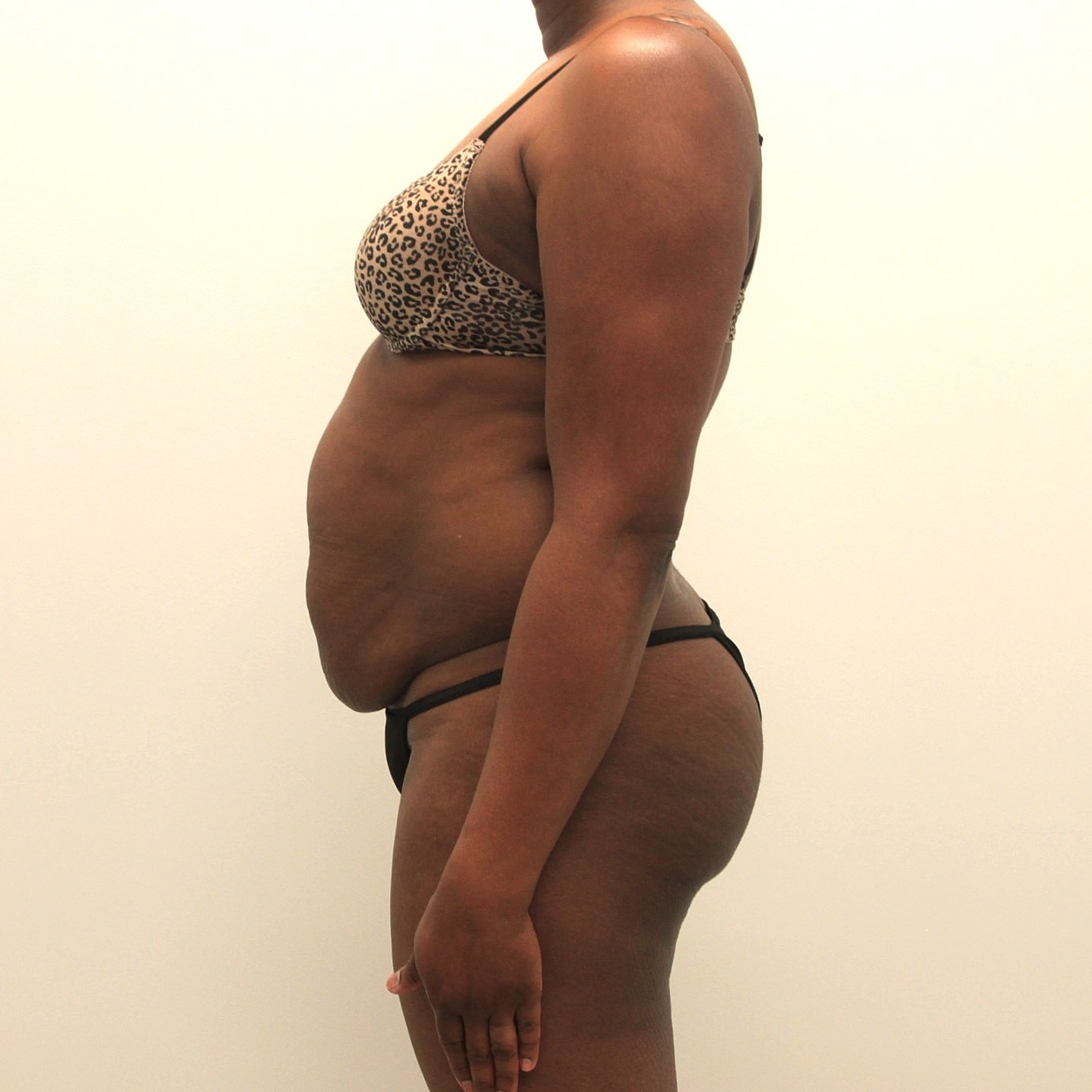 Tummy Tuck Before & After