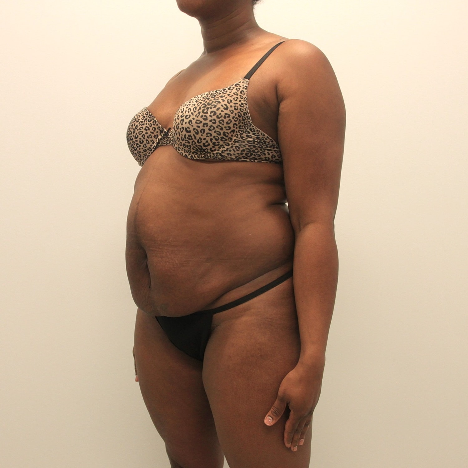 Tummy Tuck Before & After