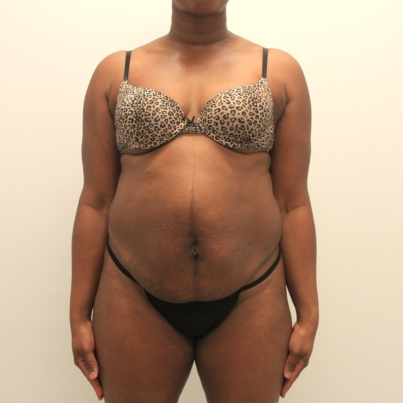 Tummy Tuck Before & After