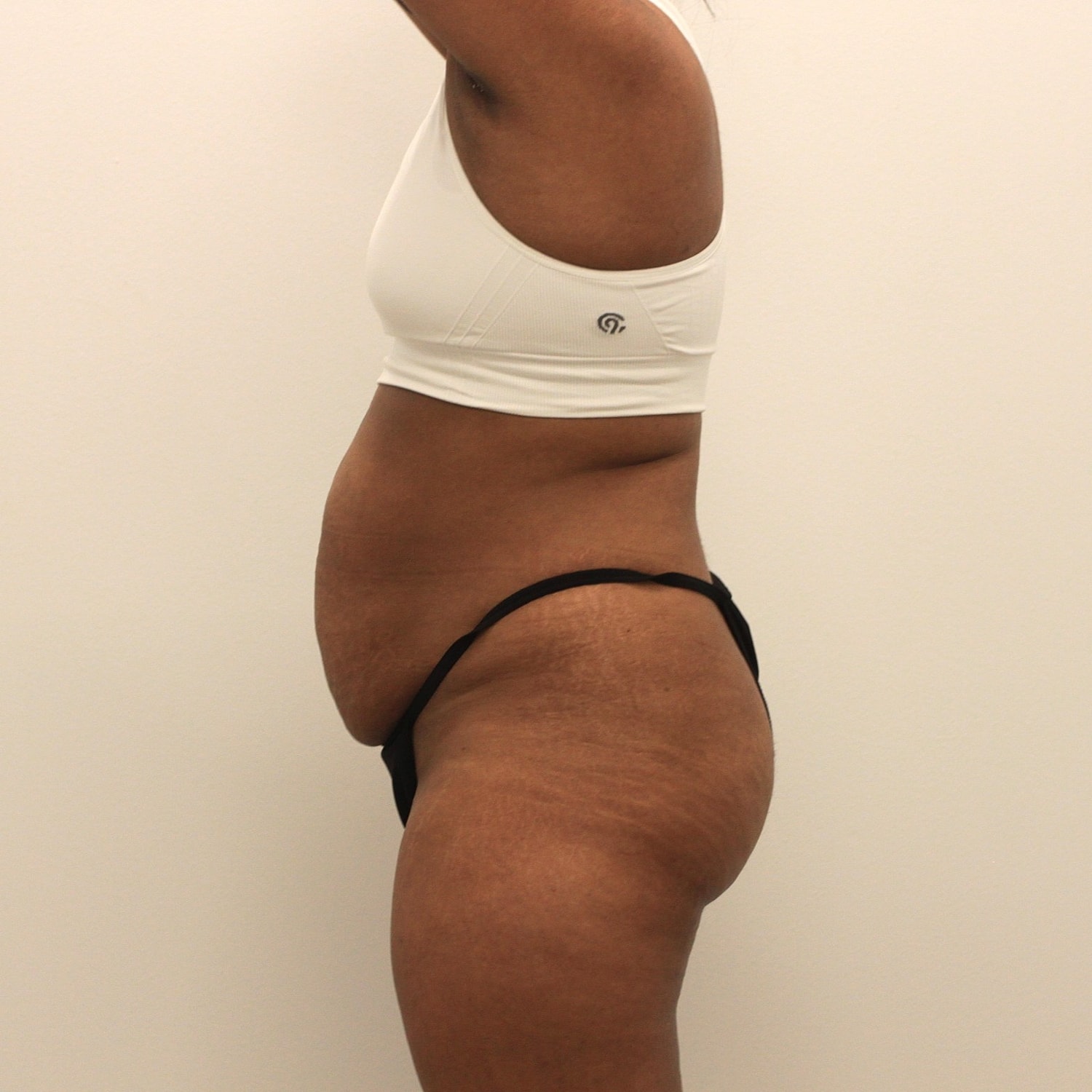 Tummy Tuck Before & After