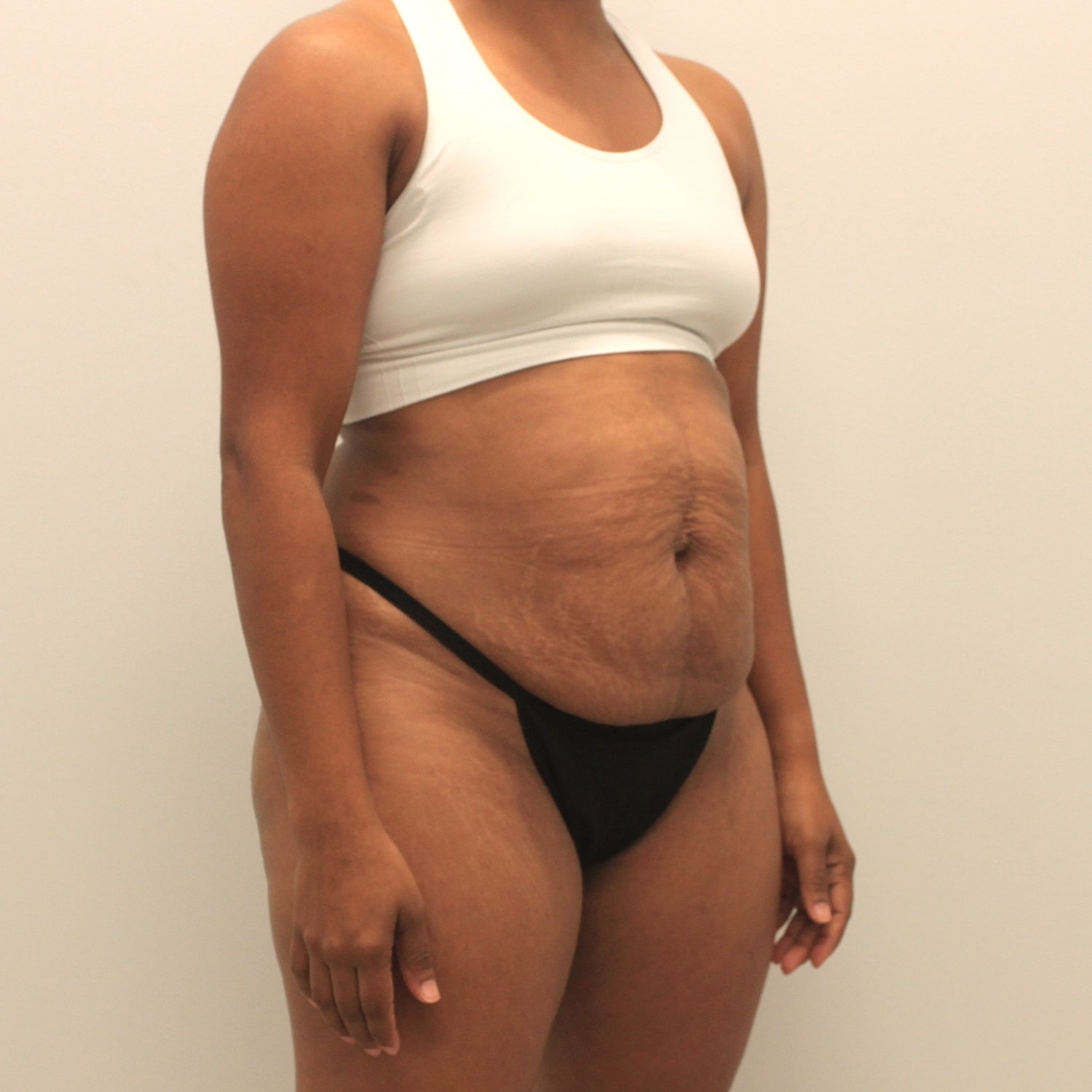 Tummy Tuck Before & After