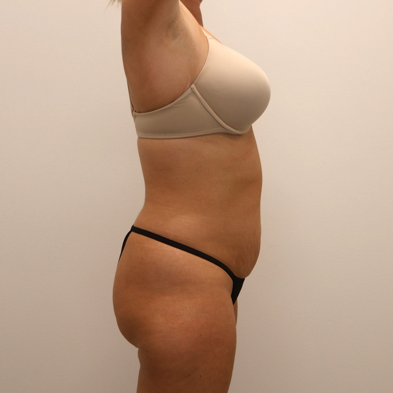 Tummy Tuck Before & After