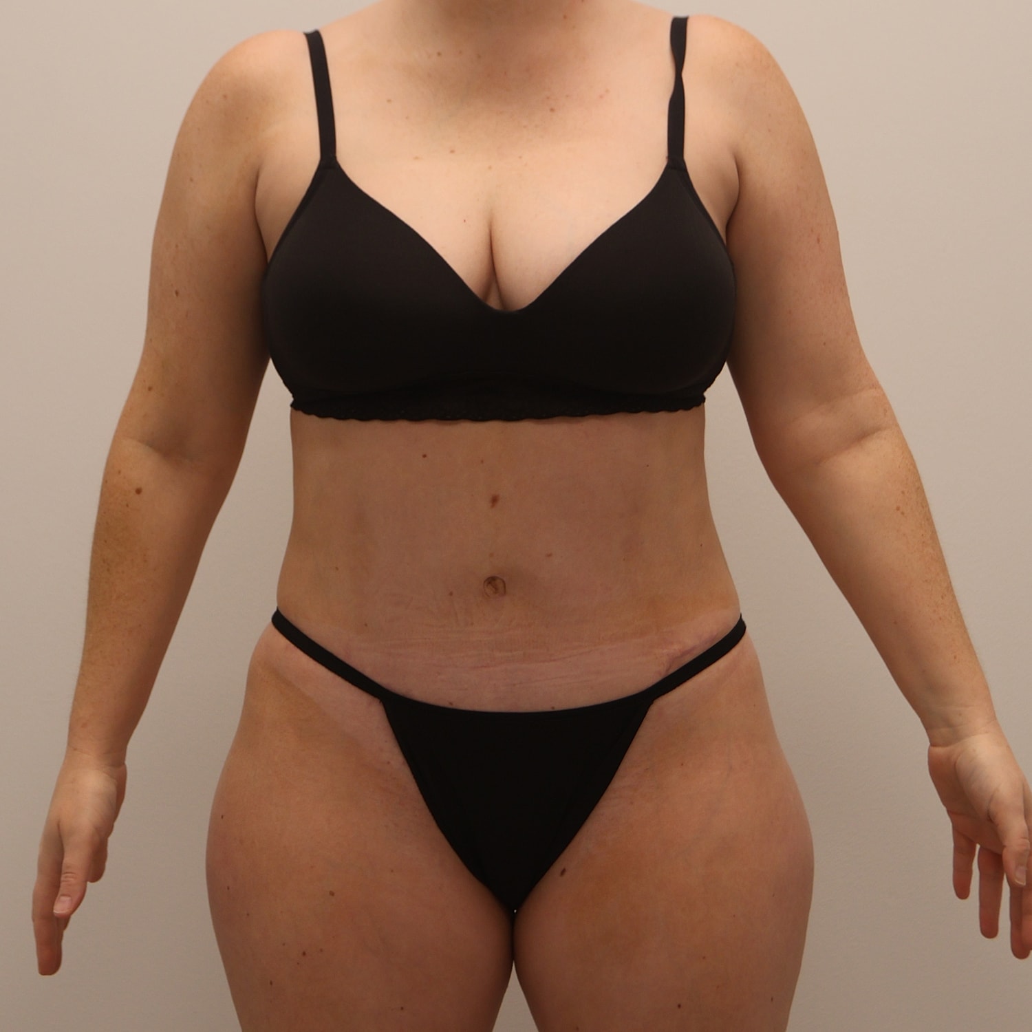 Tummy Tuck Before & After