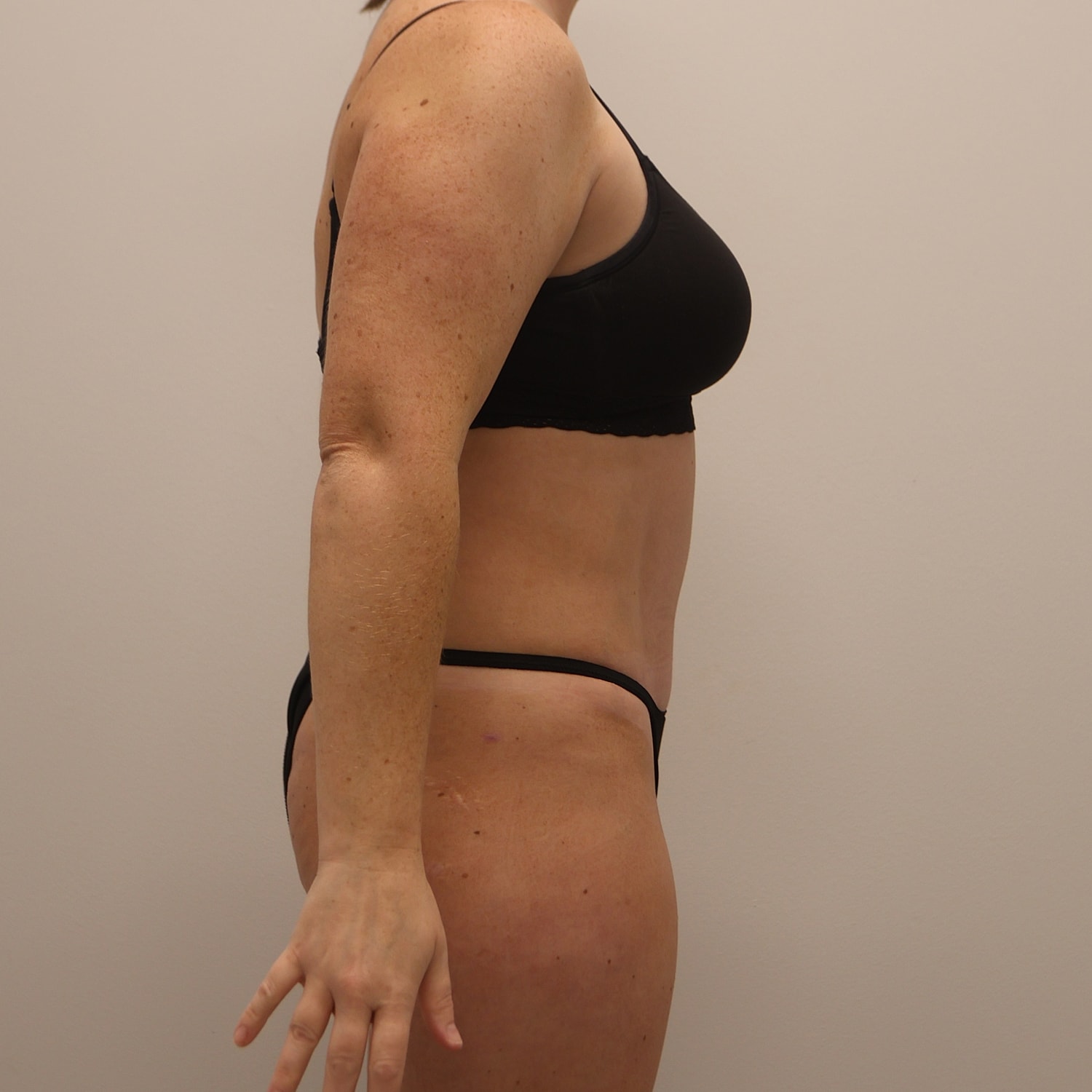 Tummy Tuck Before & After