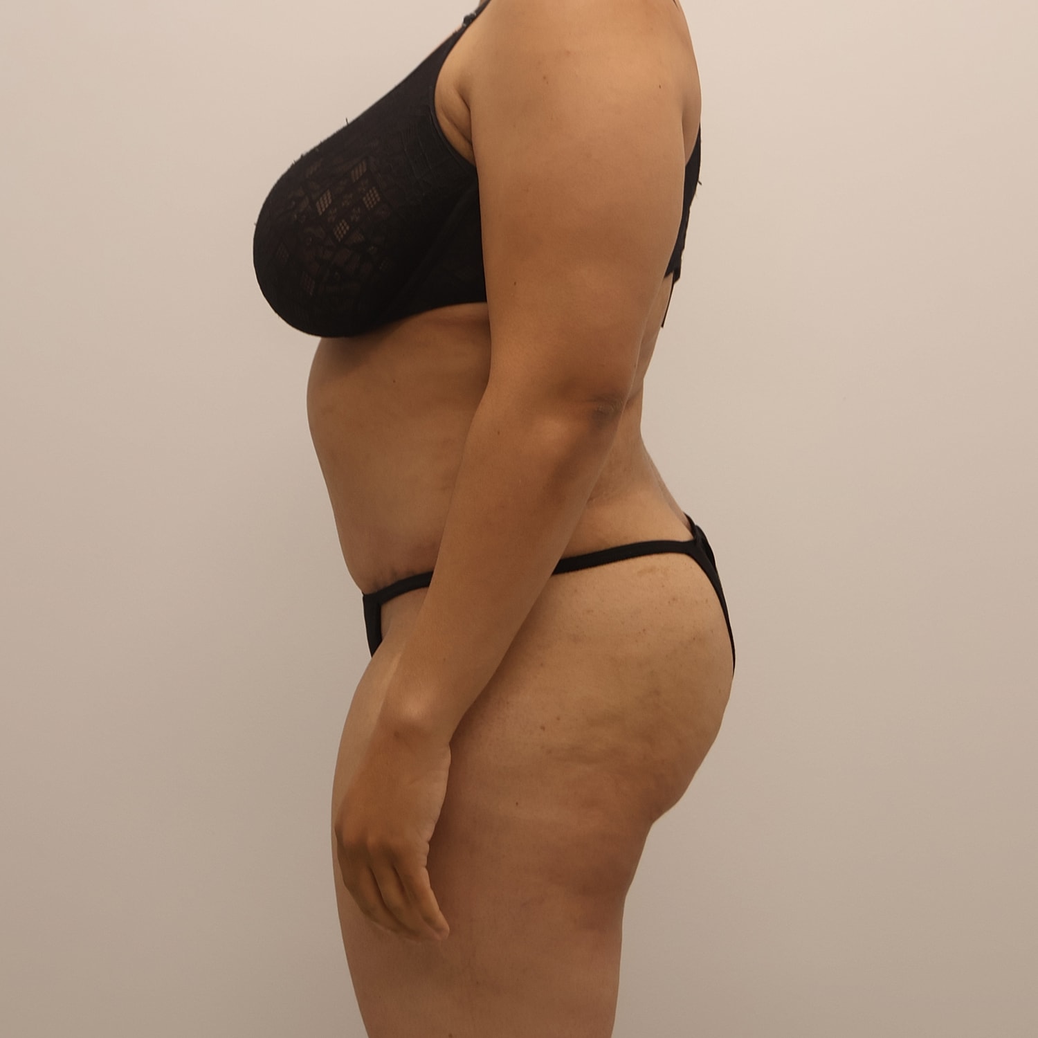 Tummy Tuck Before & After