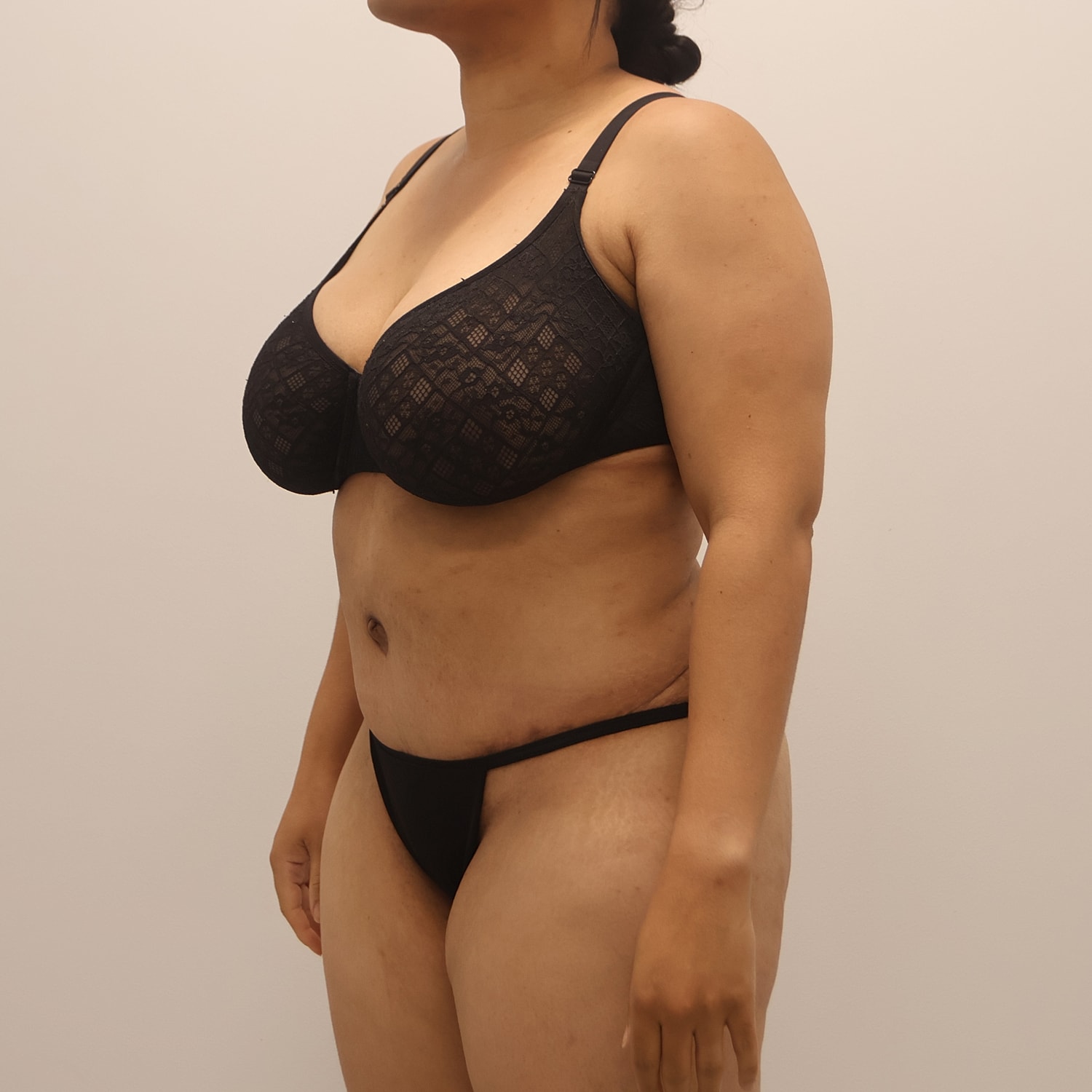 Tummy Tuck Before & After