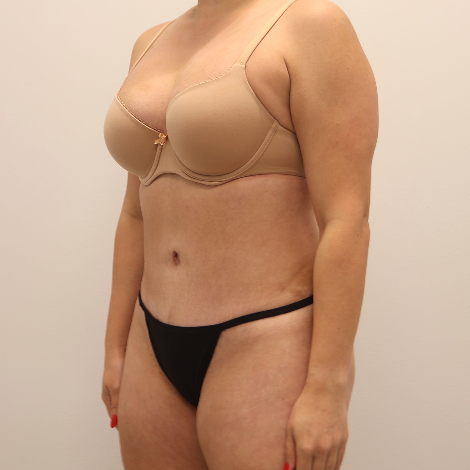 Tummy Tuck Before & After