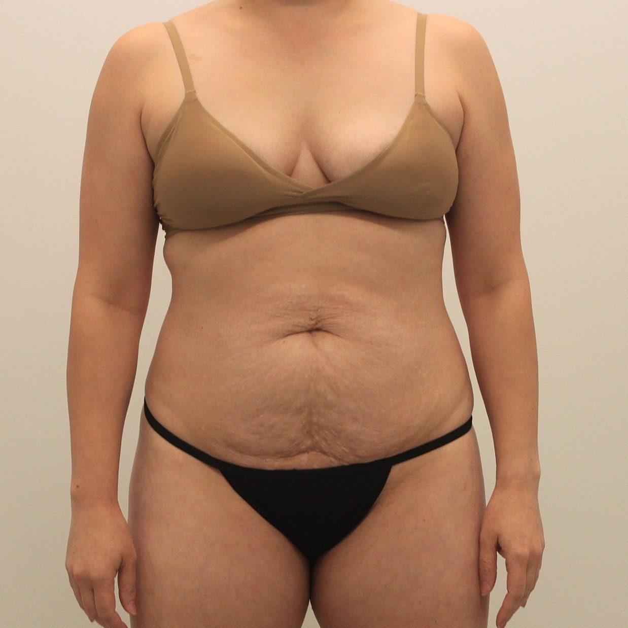 Tummy Tuck Before & After