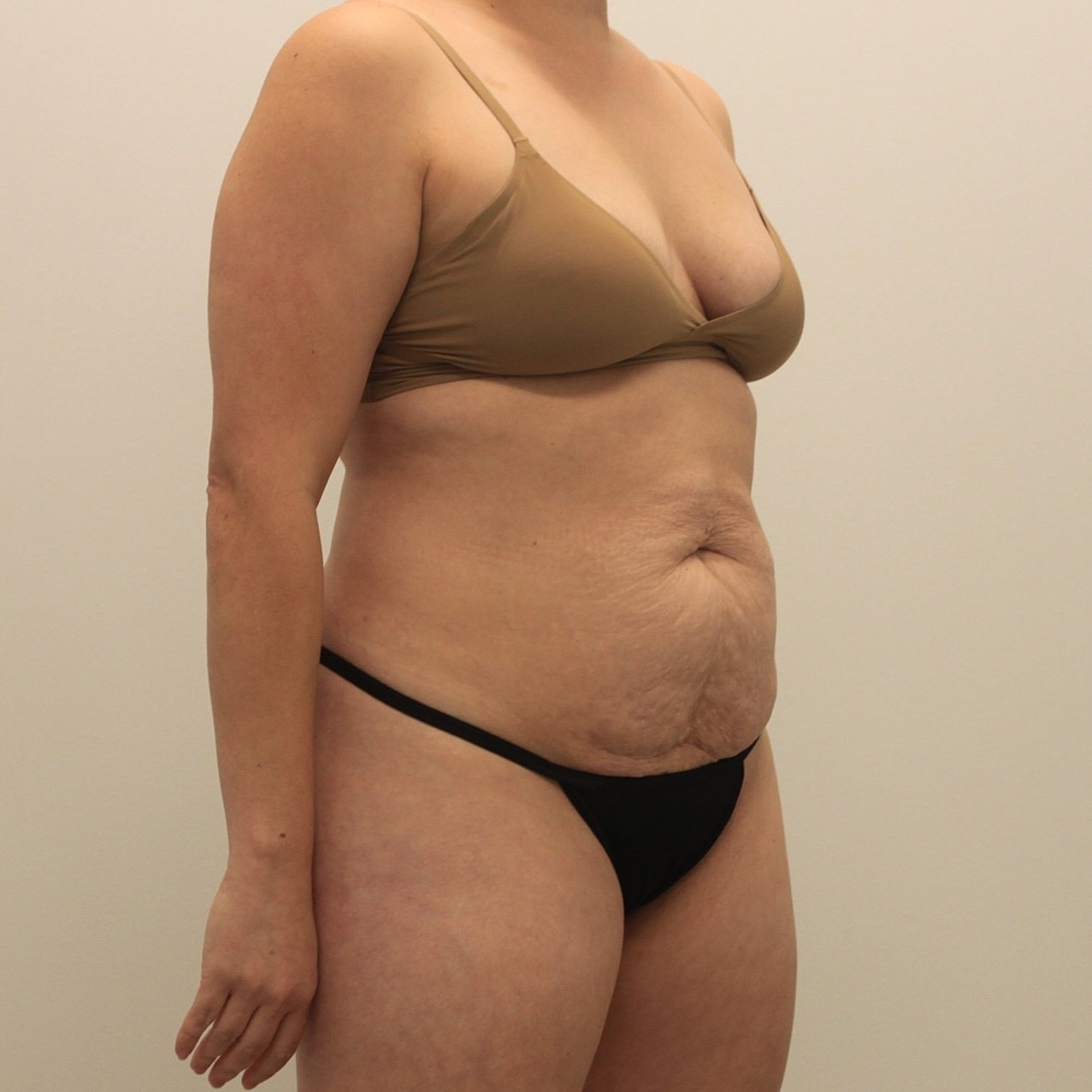 Tummy Tuck Before & After