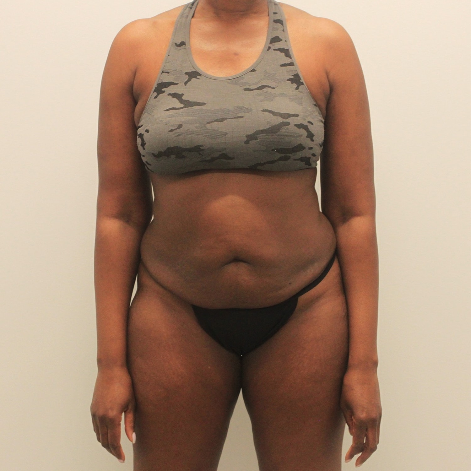 Tummy Tuck Before & After