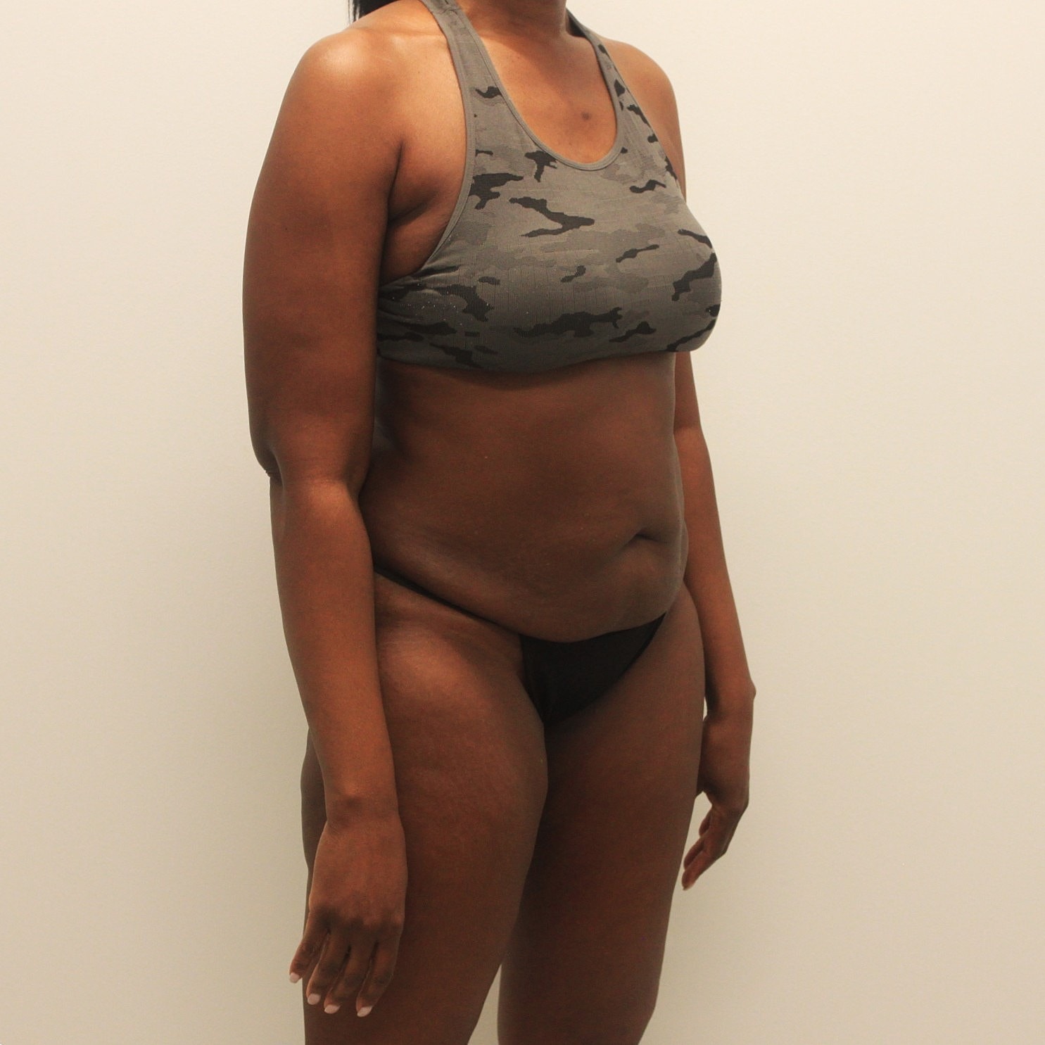 Tummy Tuck Before & After