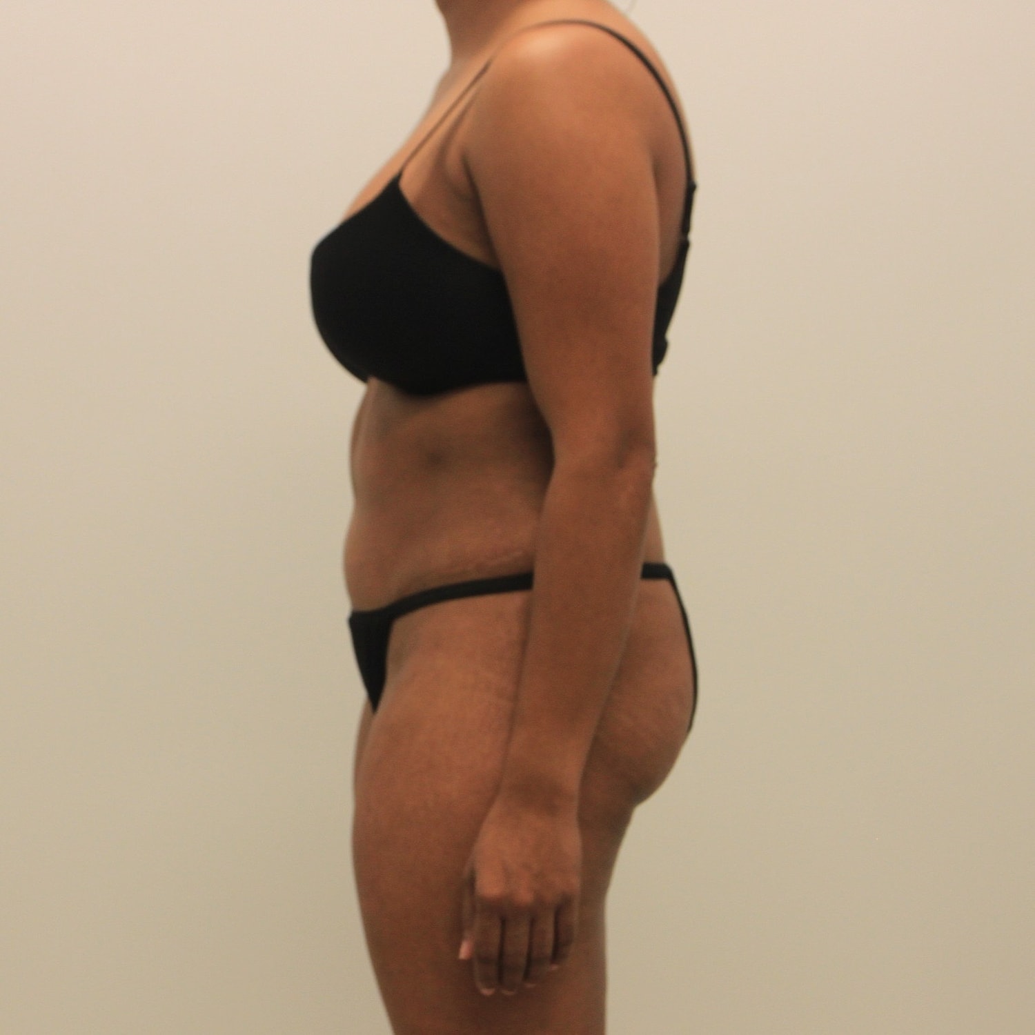 Tummy Tuck Before & After