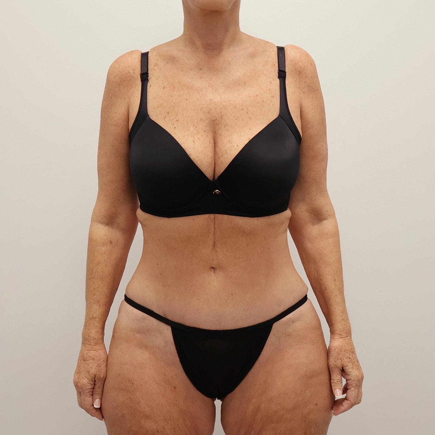 Tummy Tuck Before & After