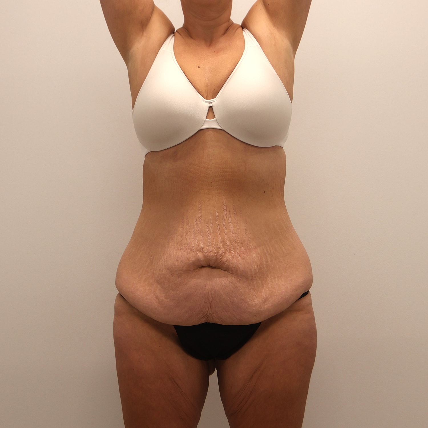 Tummy Tuck Before & After