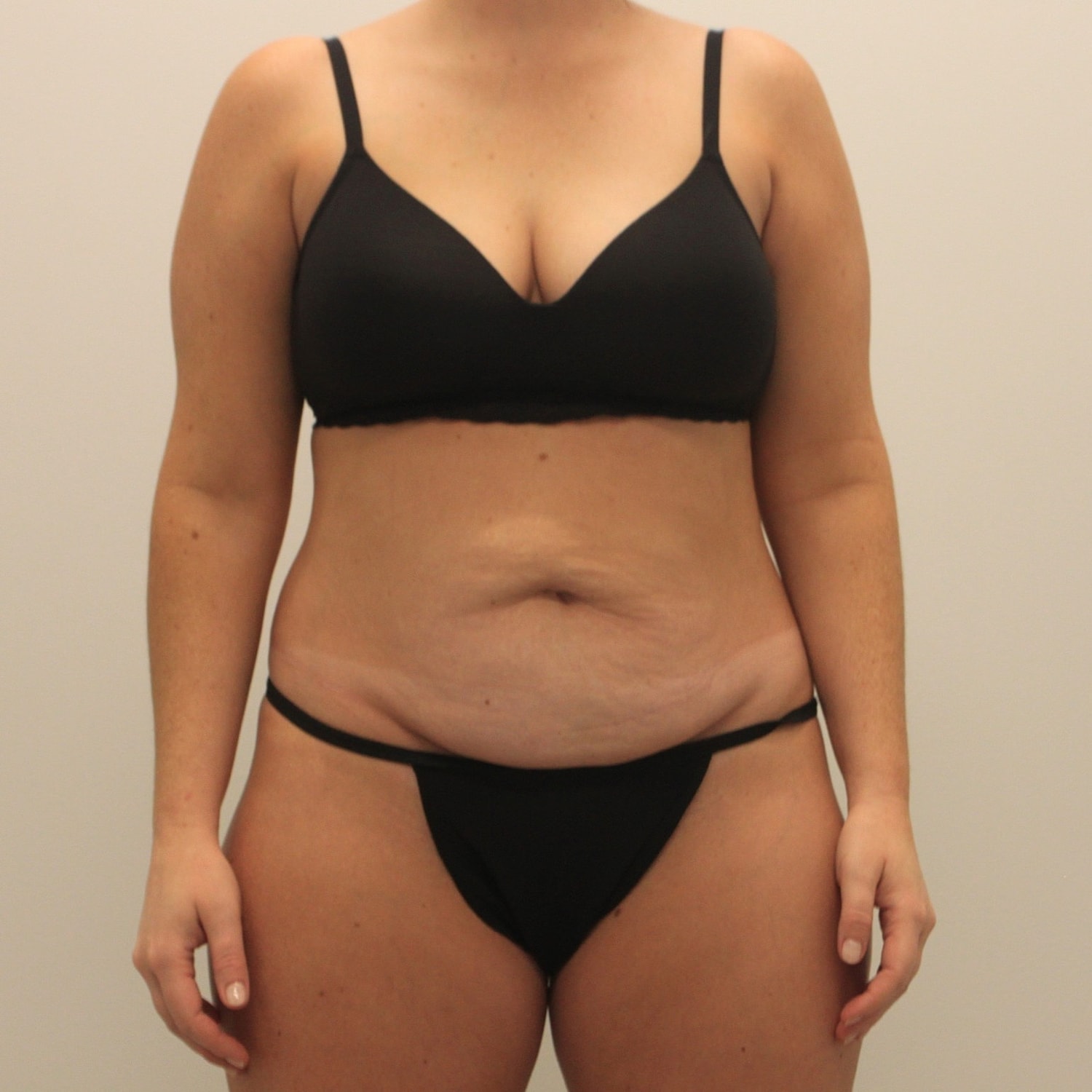 Tummy Tuck Before & After