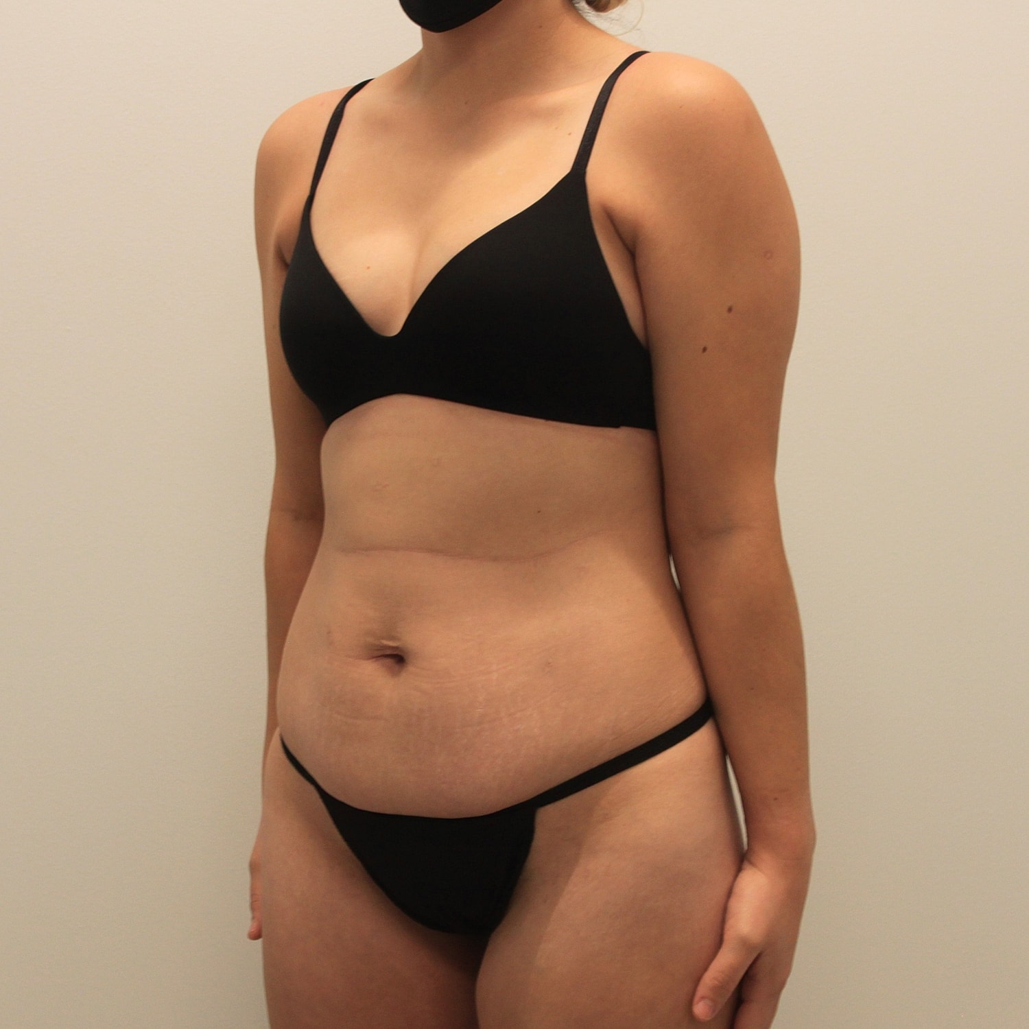 Tummy Tuck Before & After