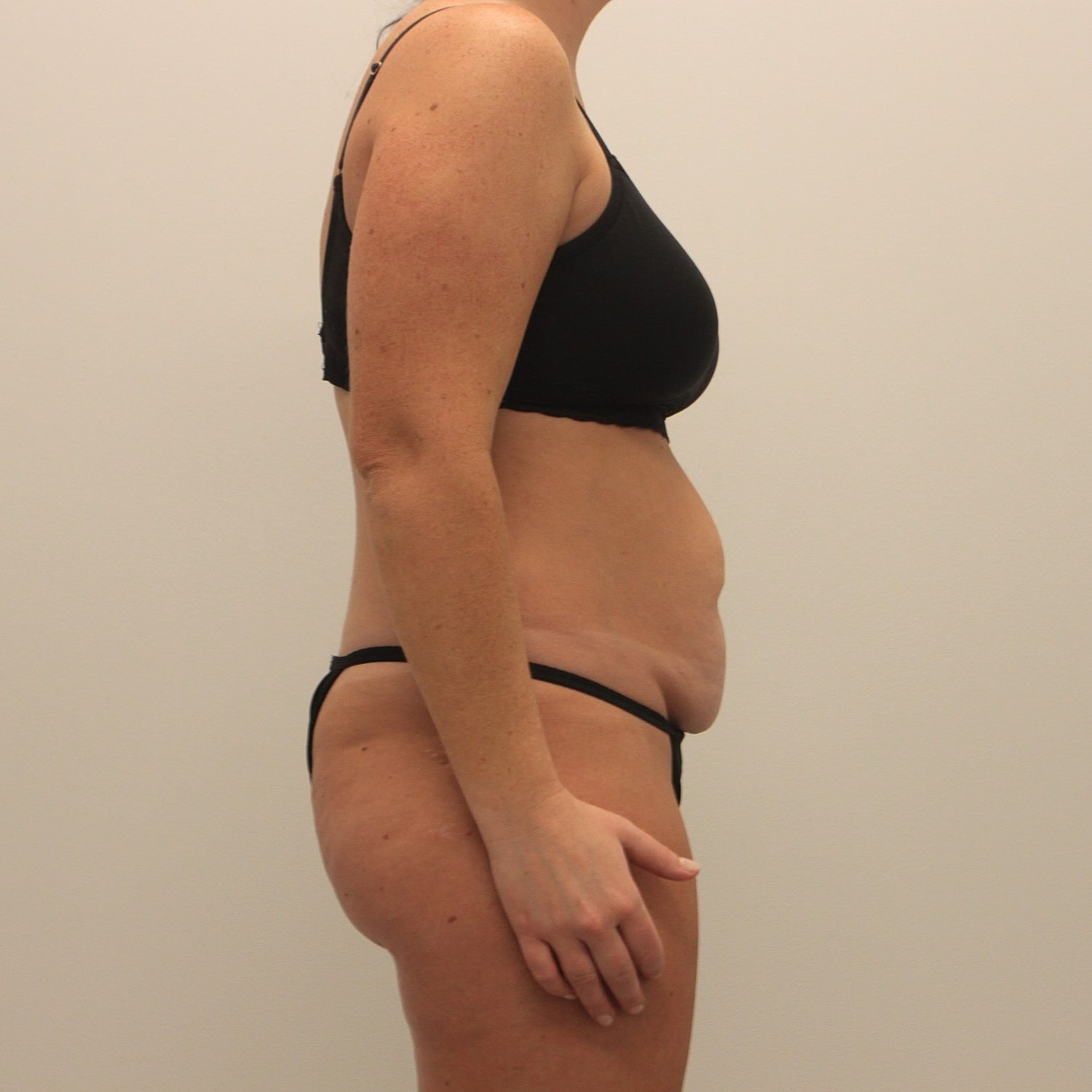 Tummy Tuck Before & After