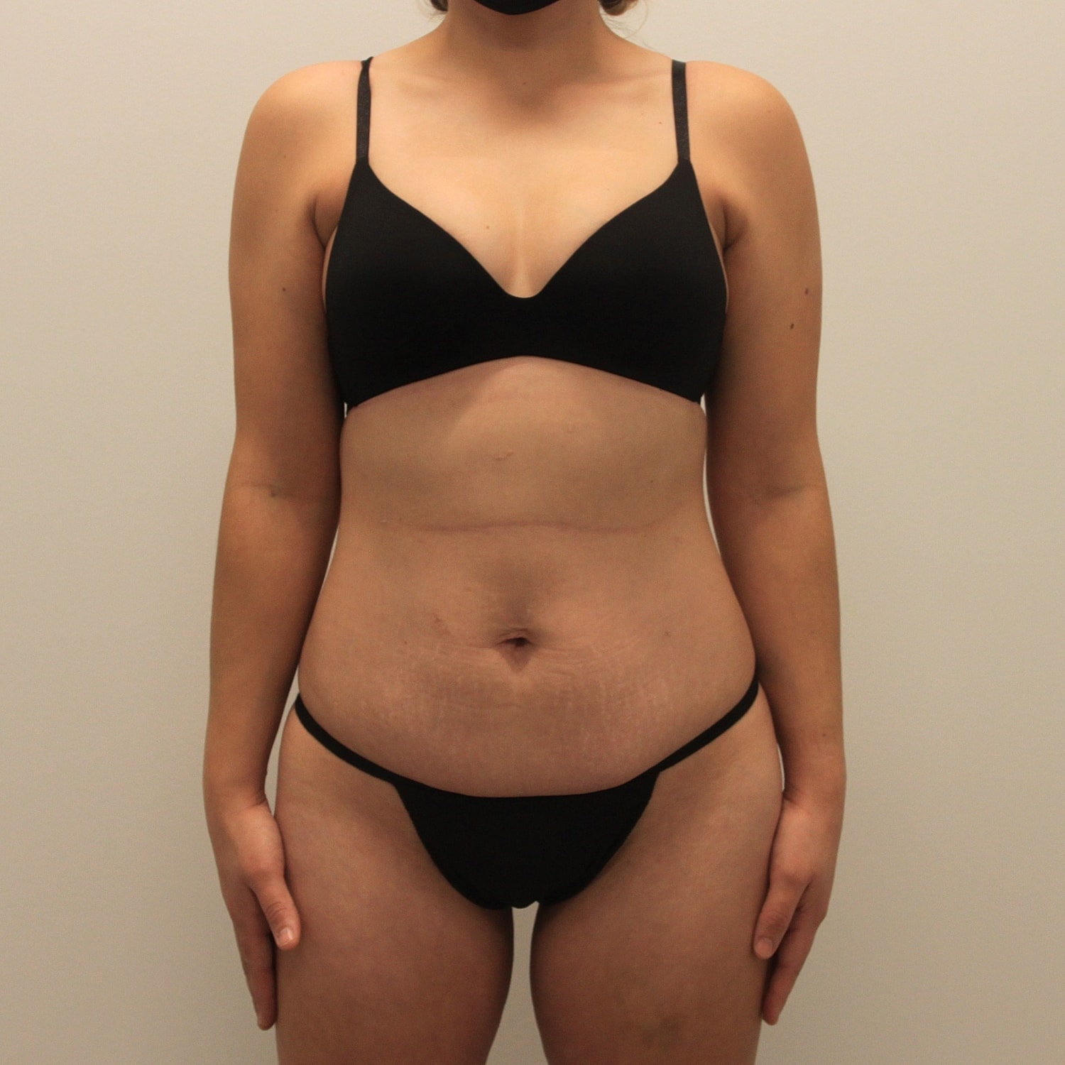 Tummy Tuck Before & After