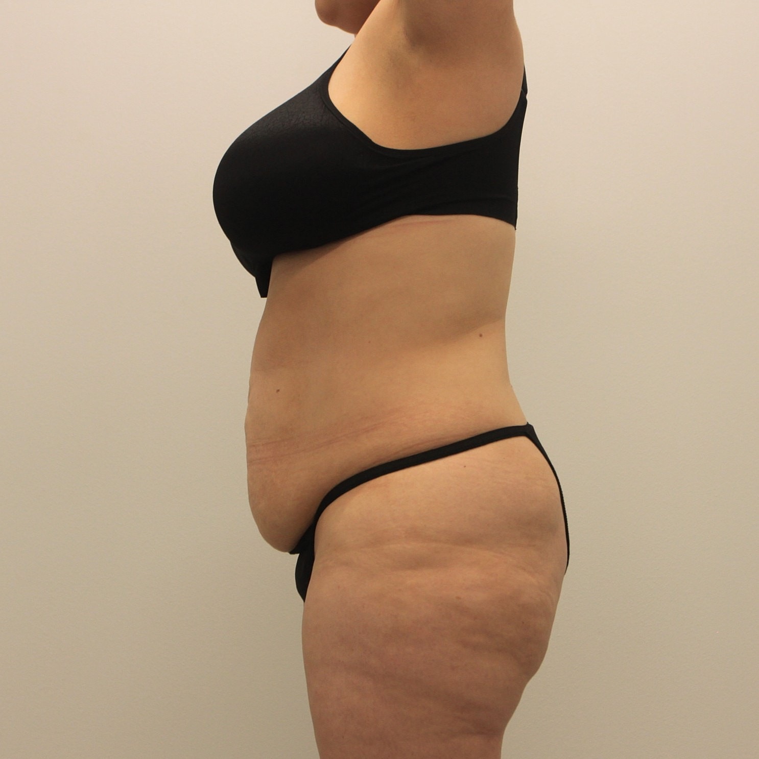 Tummy Tuck Before & After