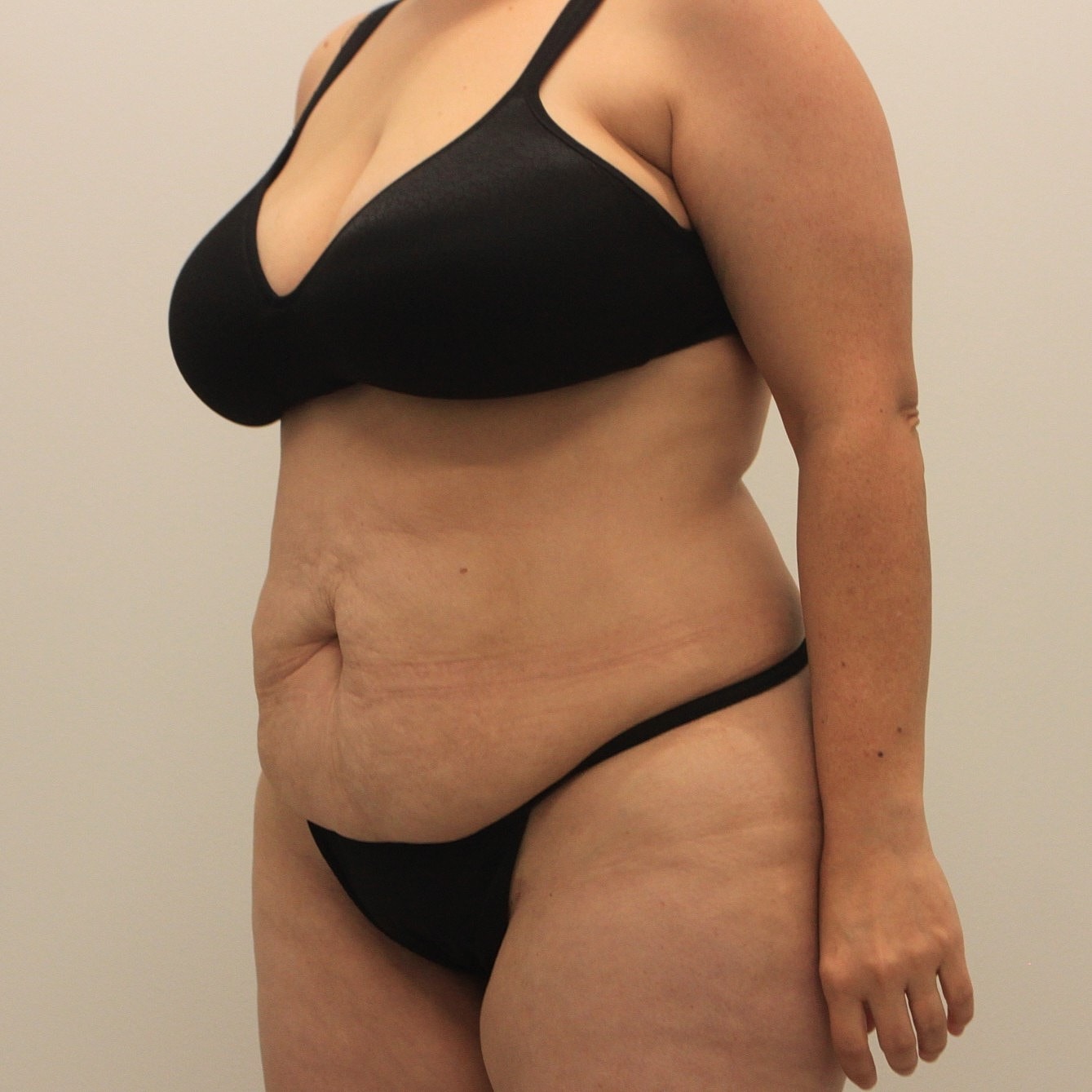 Tummy Tuck Before & After