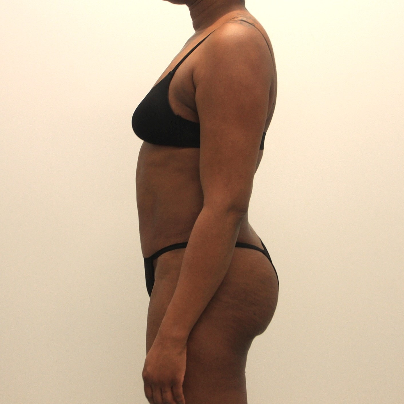 Tummy Tuck Before & After