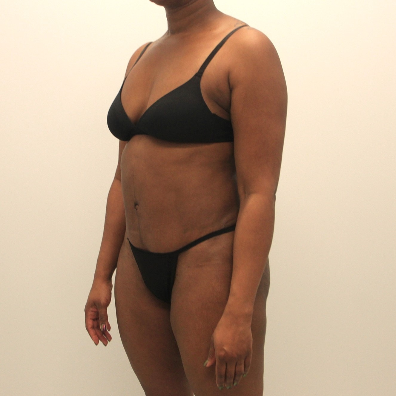 Tummy Tuck Before & After