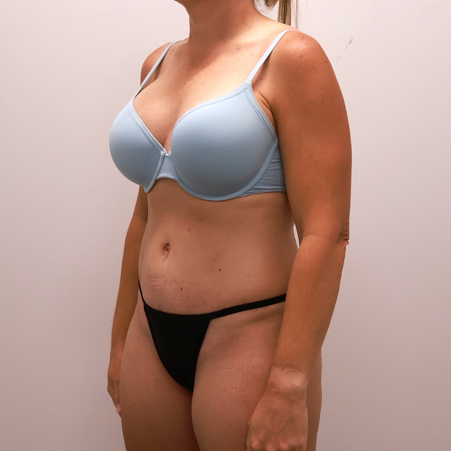 Tummy Tuck Before & After