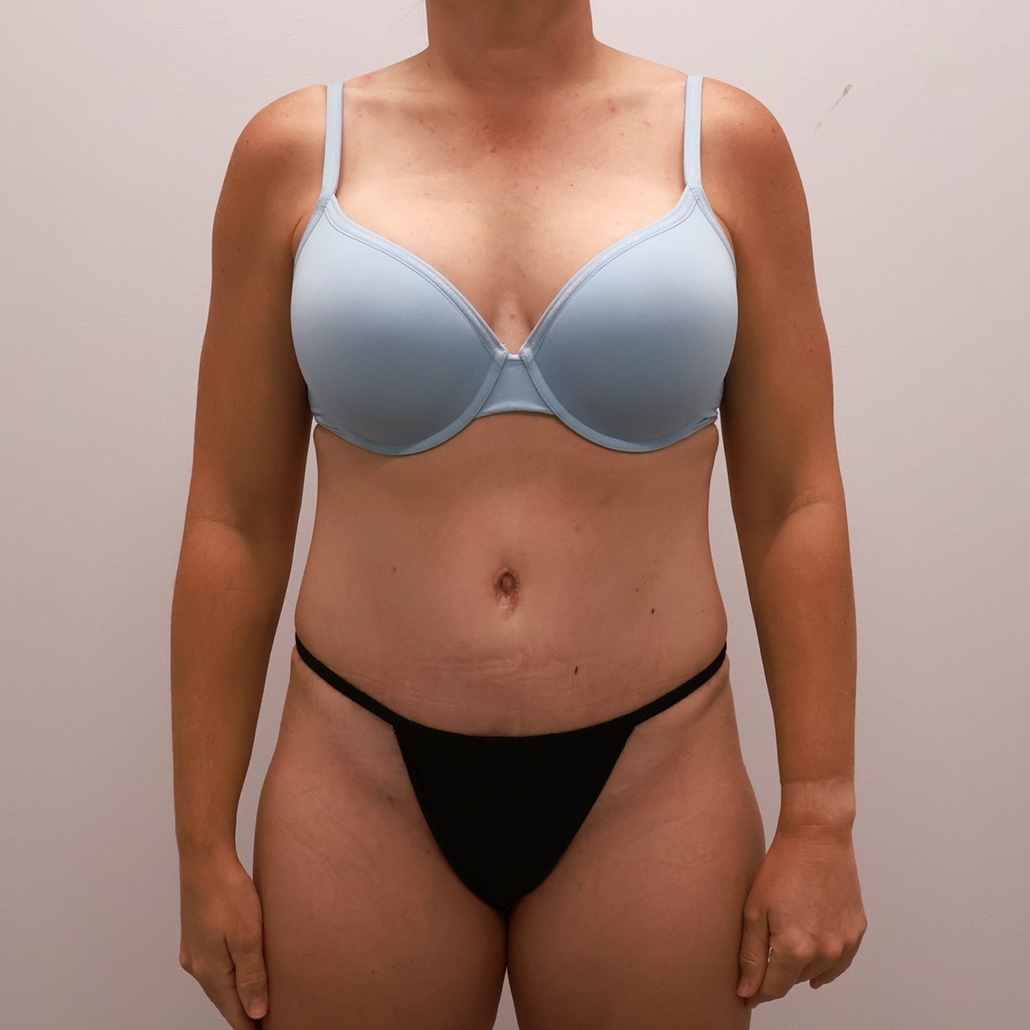 Tummy Tuck Before & After