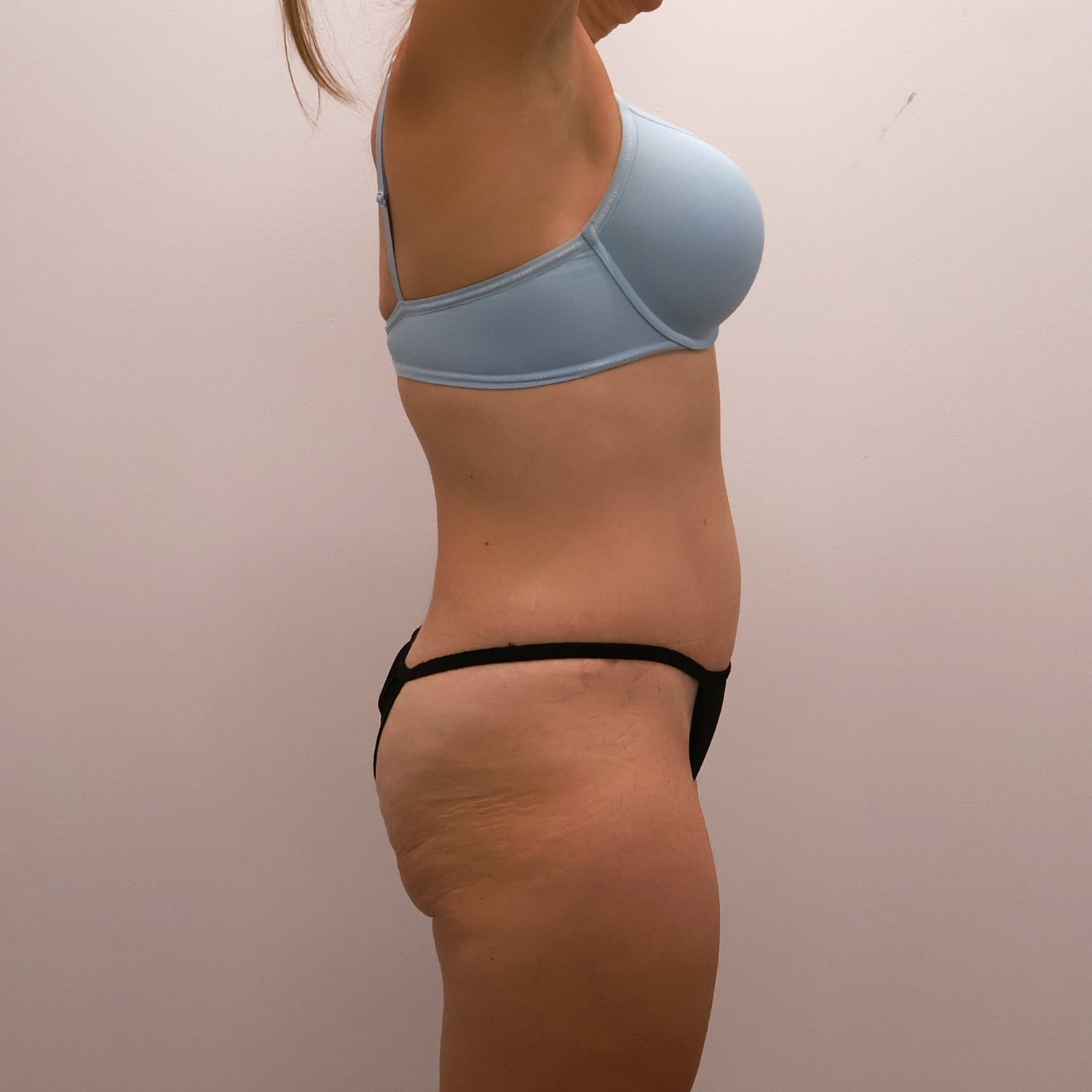 Tummy Tuck Before & After