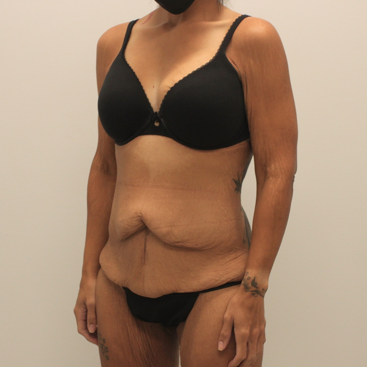 Tummy Tuck Before & After